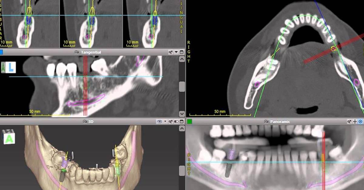 Dental Implant & Computer Guided Implant Treatment – Grace Dental Care ...